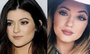 preenchimento labial