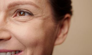 Tratamentos topicos para rugas dinamicas 18cc22d4