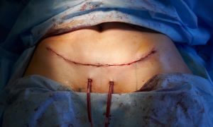 female patient abdomen with suture line after abdo 2022 05 28 10 48 38 utc scaled 1f0b001c