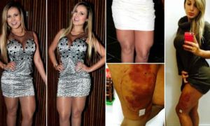 andressa urach hidrogel hm 5d7bccdf