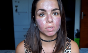 Microagulhamento caseiro