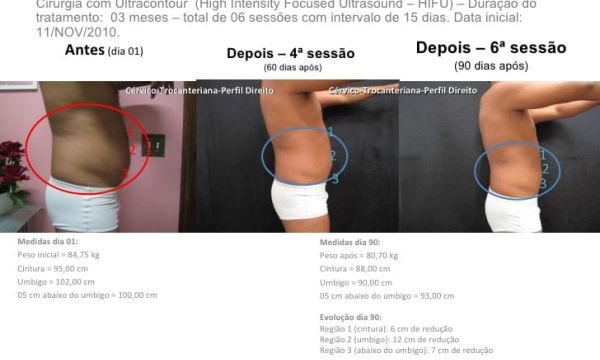 Lipo sem cirurgia não invasiva