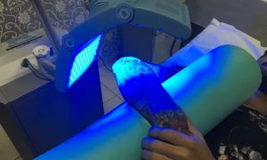 remocao de tatuagem 84206a8b