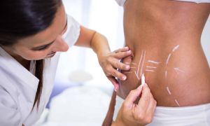 Gordura Localizada - Biomedicina Estética