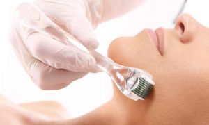 Palestra sobre Desintoxicação na Biomedicina Estética será um dos temas do 3º Congresso Brasileiro de Biomedicina Estética 7 dermaroller 02 scaled b739f763