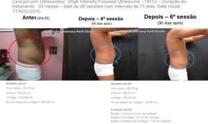 Acabe Com as Gorduras Indesejadas sem Cirurgia e sem Sentir Dor 3 Lipo sem cirurgia não invasiva