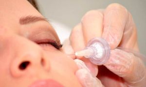 carboxiterapia e4387a02