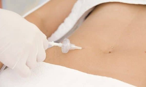 Biomédicos estetas participam do curso de especialização em Florianópolis-SC 5 carboxiterapia