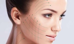 fios absorviveis lifting sem cortes dermatologia e saude eb76615c