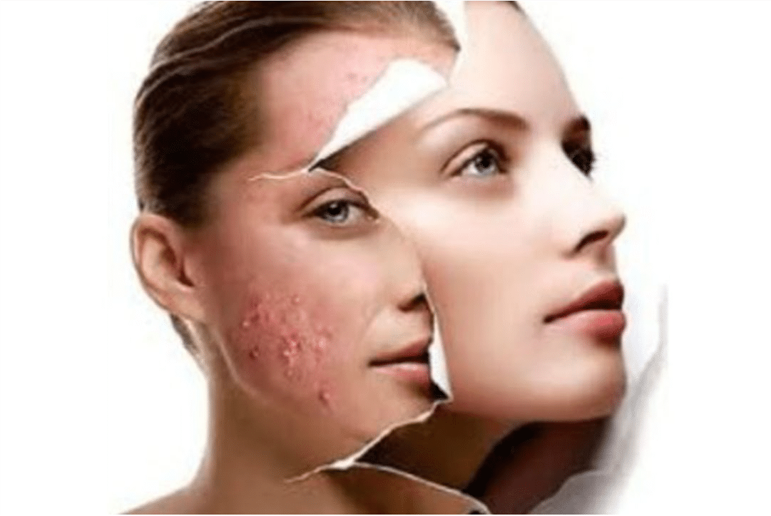 Tratamento da acne com Toxina botulínica
