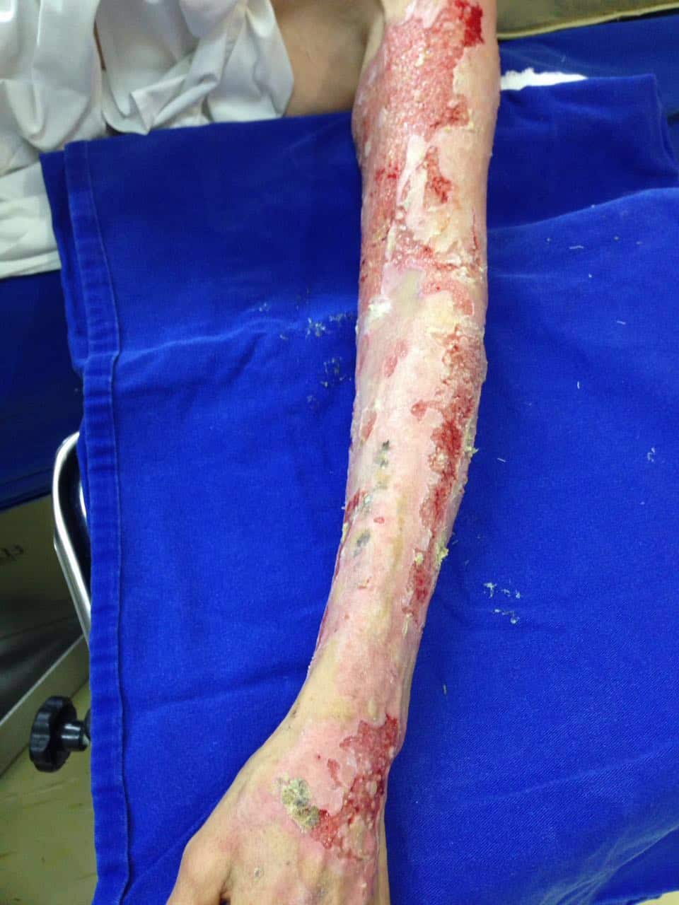 Peeling de Fenol causa queimadura de terceiro grau em paciente; SBBME lança alerta para profissionais da estética