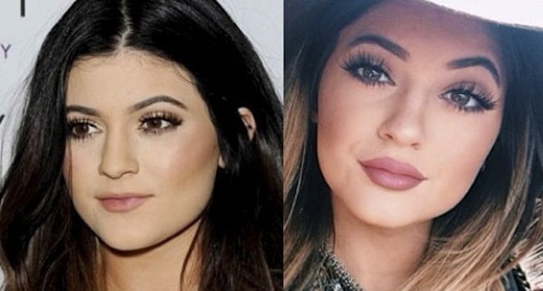 Dez fatos sobre: Preenchimento Labial, o queridinho das famosas