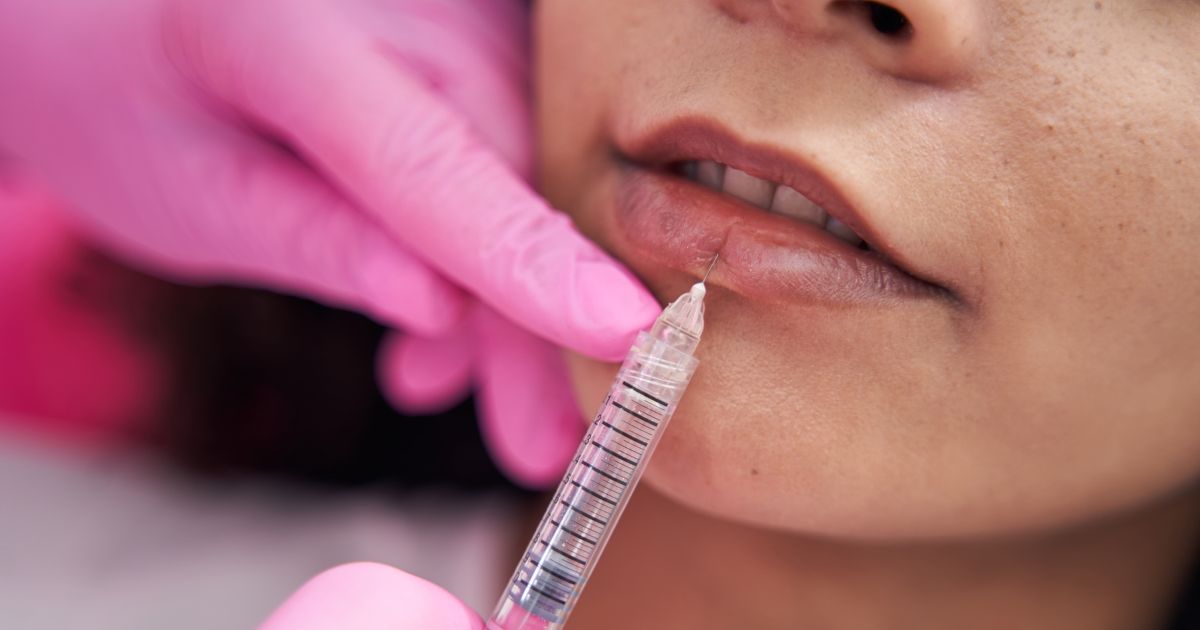 Anvisa libera uso profundo de ácido hialurônico nacional: o que isso representa para quem atua com estética?