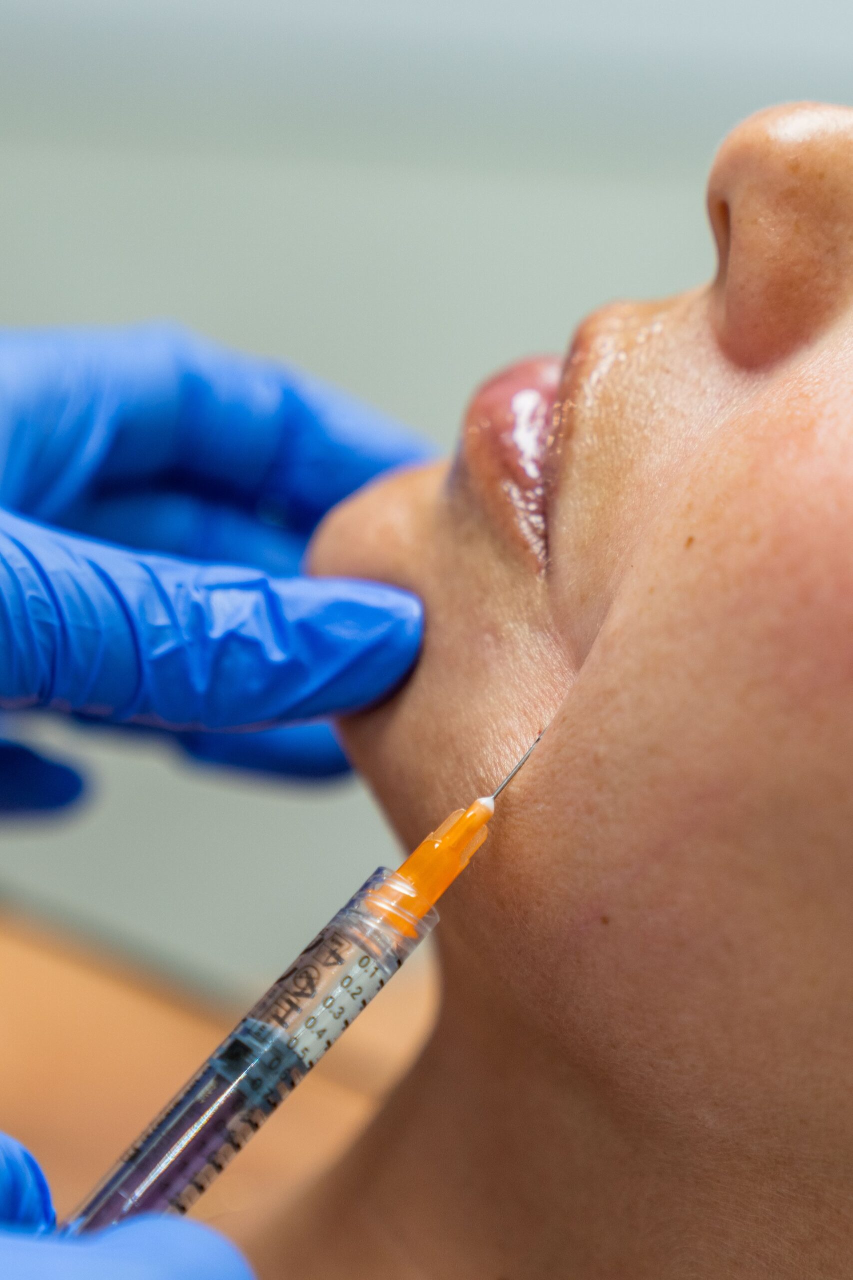 Qual a idade ideal para indicar que seus pacientes comecem com bioestimuladores de colágeno?